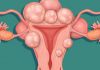 U xơ tử cung và những điều bạn nên biết